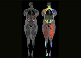 AMRA Fat and musceles in an MR scan